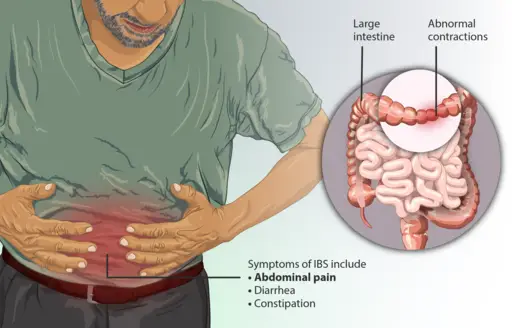 Ibs Symptoms Ibs Symptoms: Abdominal Pain, Bloating, Diarrhea, And Constipation
