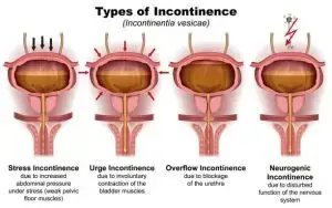 Urinary Incontience Types Of Incontience